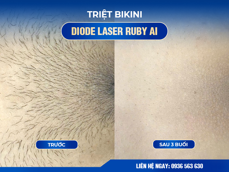 khách hàng sau khi Triệt lông bikini  bằng công nghệ ruby AI