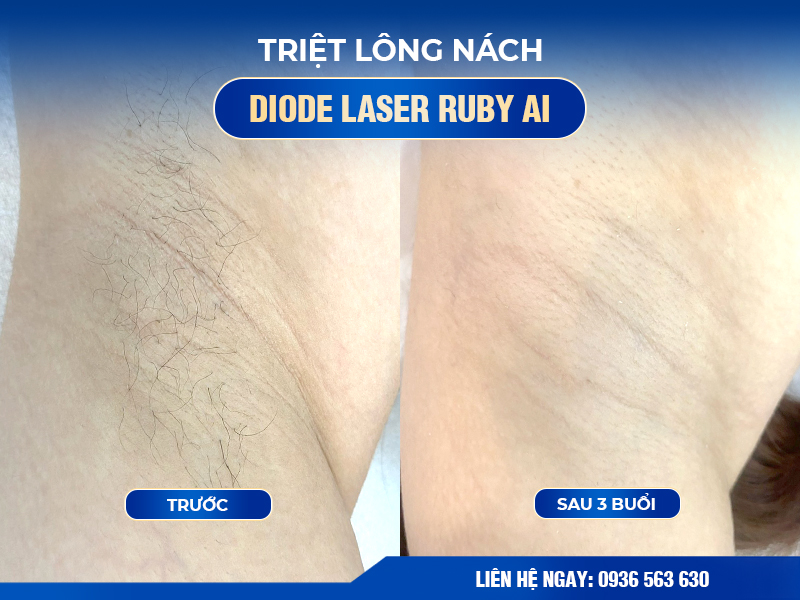 Dịch vụ triệt lông nách