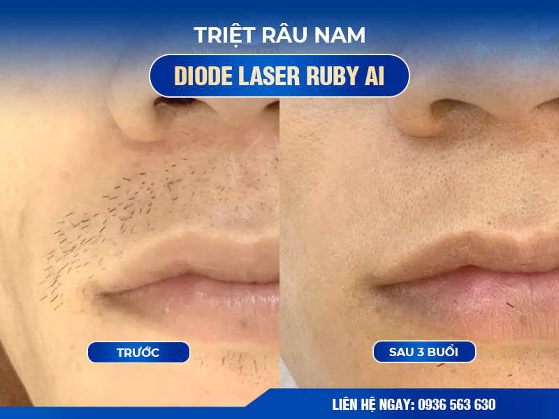 feedback khách hàng sau khi Triệt lông mặt - ria -mép bằng công nghệ ruby AI