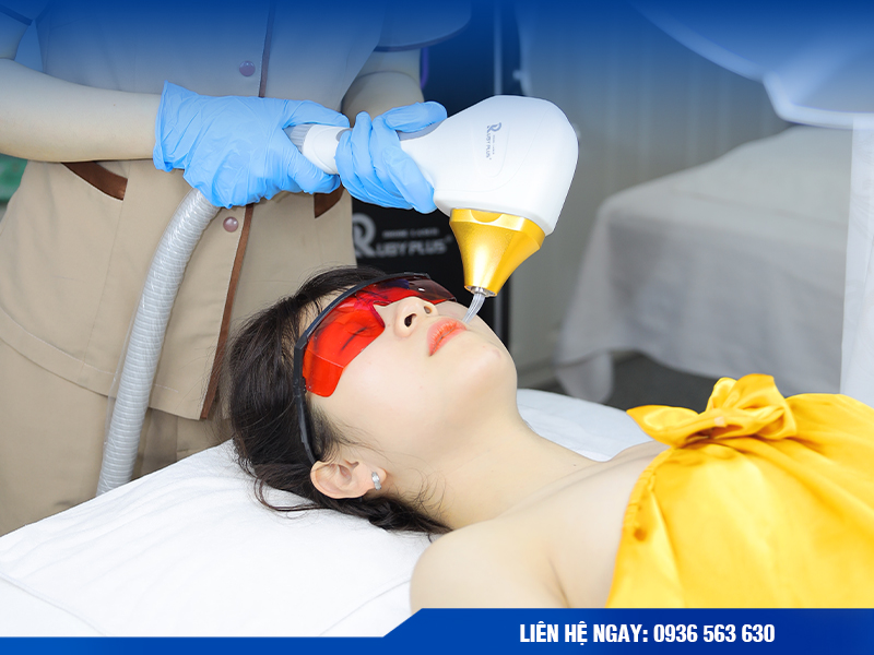 Triệt lông mặt - ria -mép bằng công nghệ ruby AI