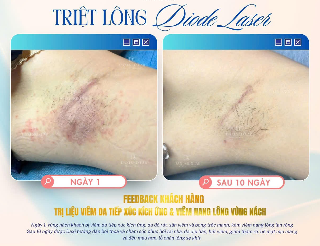 Triệt lông công nghệ cao