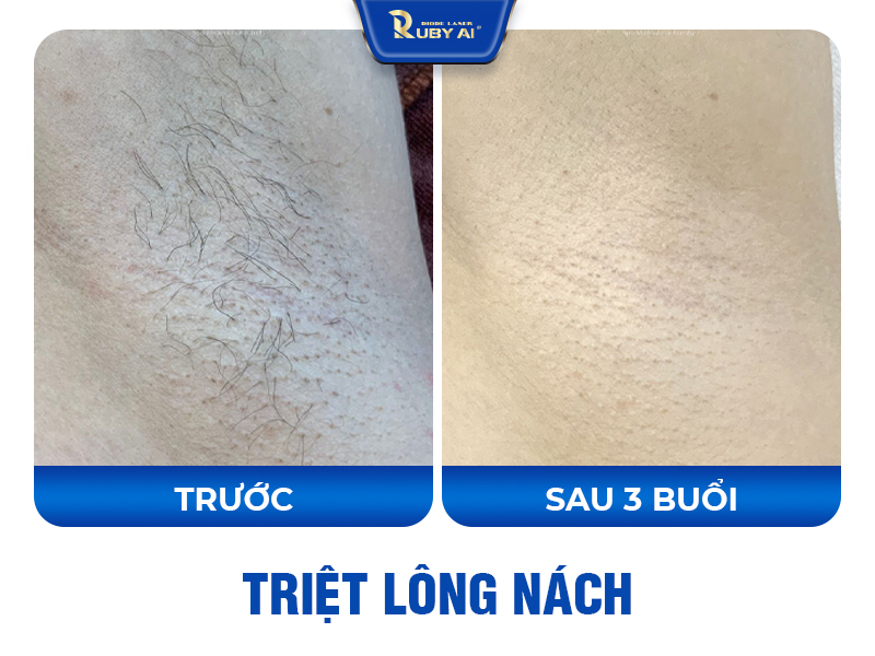 Công Nghệ Diode Laser Ruby AI Là Gì? 3 Bước song Xu Hướng Triệt Lông 2025?